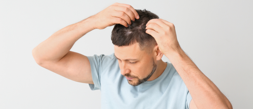 Saç Dökülmesi ve Tedavisi